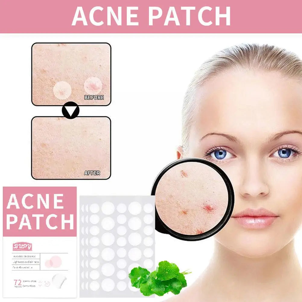 Tea Tree Acne Patches - 72 Pieces